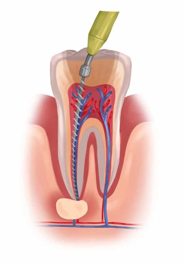 Root Canal Treatment